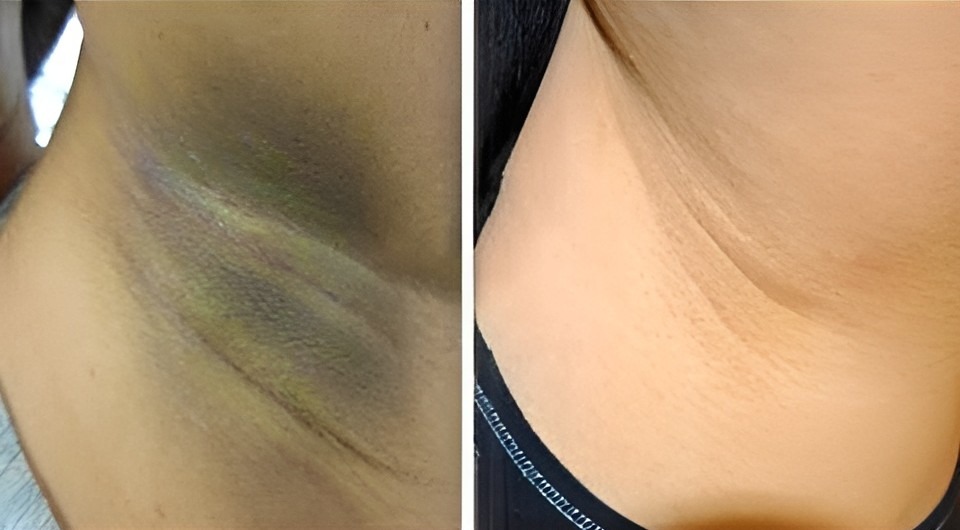 Antes e depois de axila escura clarificada