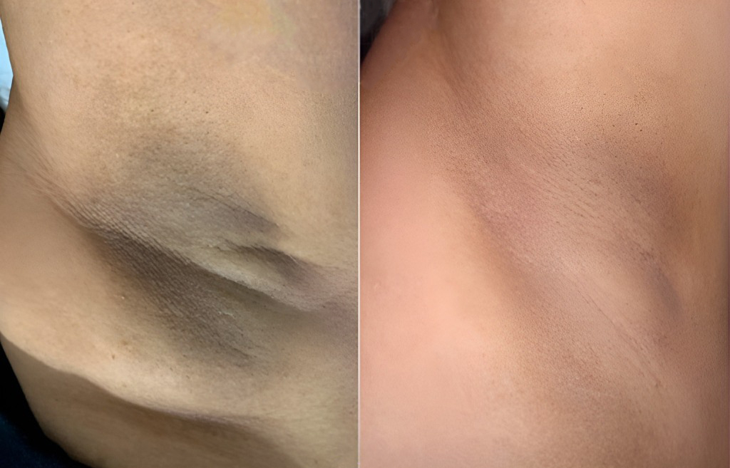 Antes e depois de axila com manchas escurecidas
