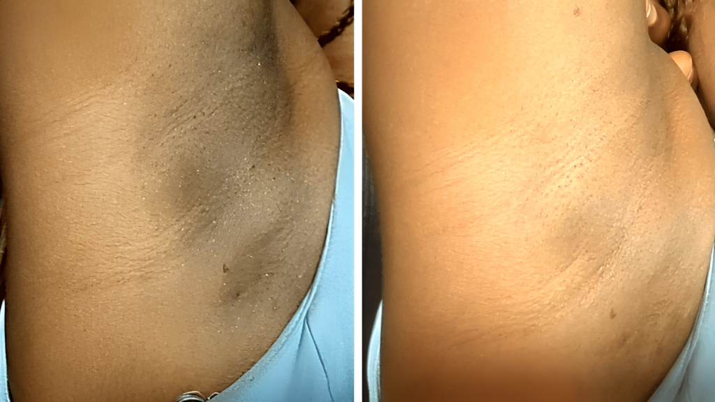 Antes e depois de virilha escurecida clarificada